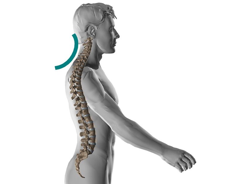 Dzemdes kakla mugurkaula osteohondroze, izraisot daudzus nepatīkamus simptomus