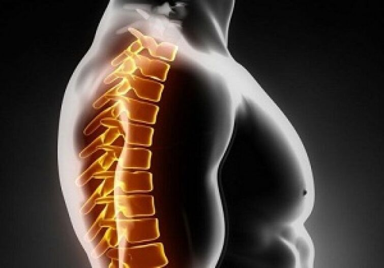 Torakālā osteohondroze pavada sāpes un diskomfortu muguras vidū